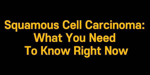 Squamous Cell Carcinoma: What You Need To Know Right Now